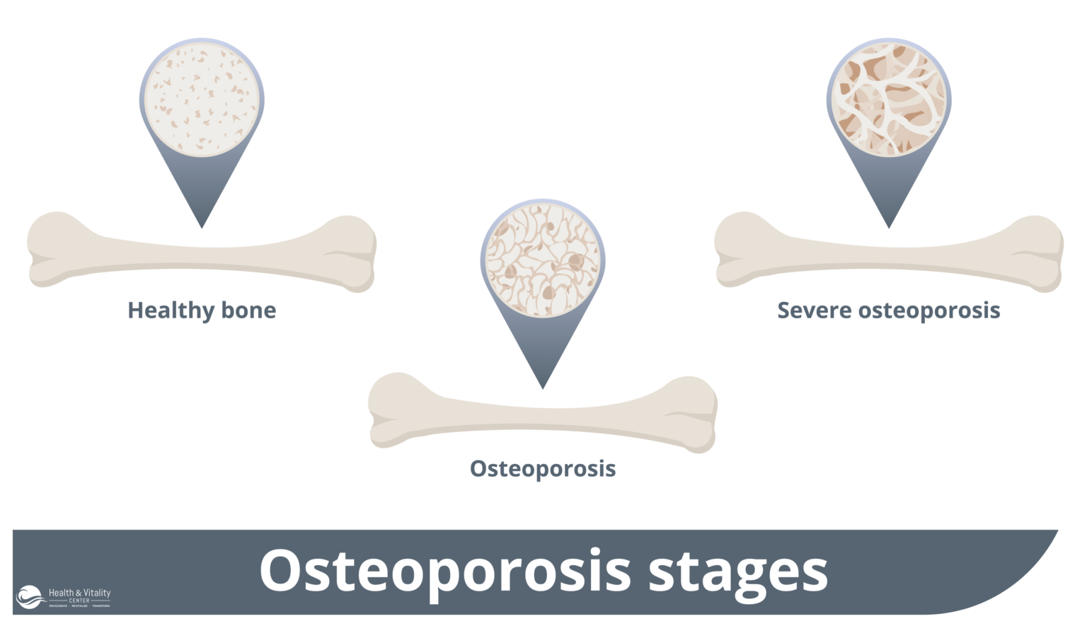 Osteoporosis infographic