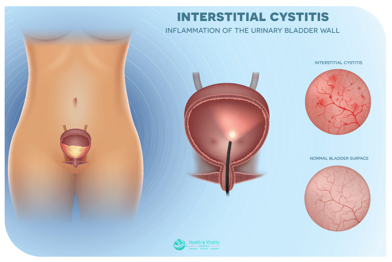 Interstitial Cystitis infographic