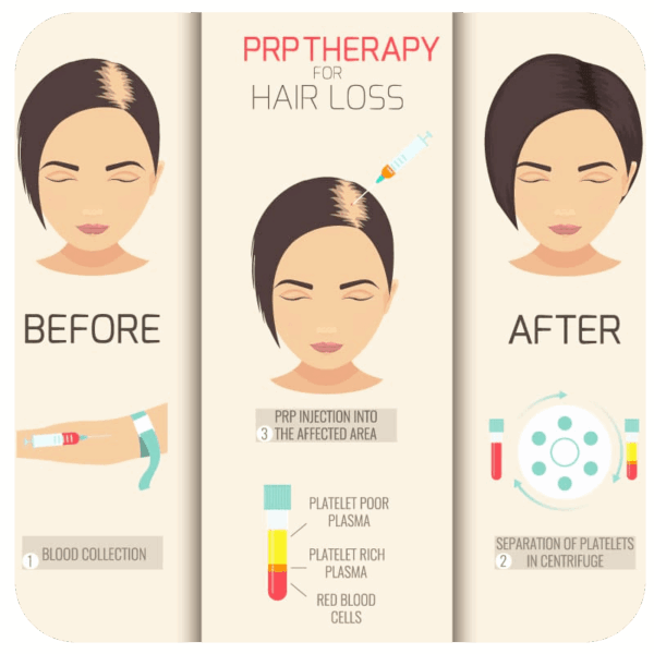 PRP therapy infographic