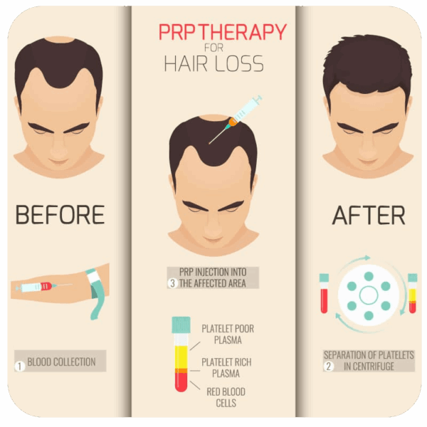 prp therapy infographic