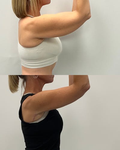 Arm Lift Before & After Gallery - Patient 238543 - Image 1