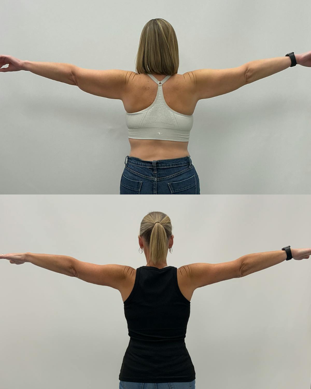 Arm Lift Before & After Gallery - Patient 238543 - Image 5