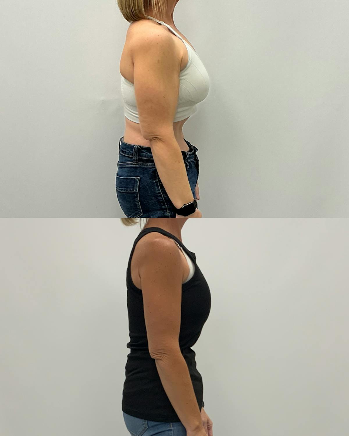 Arm Lift Before & After Gallery - Patient 238543 - Image 3