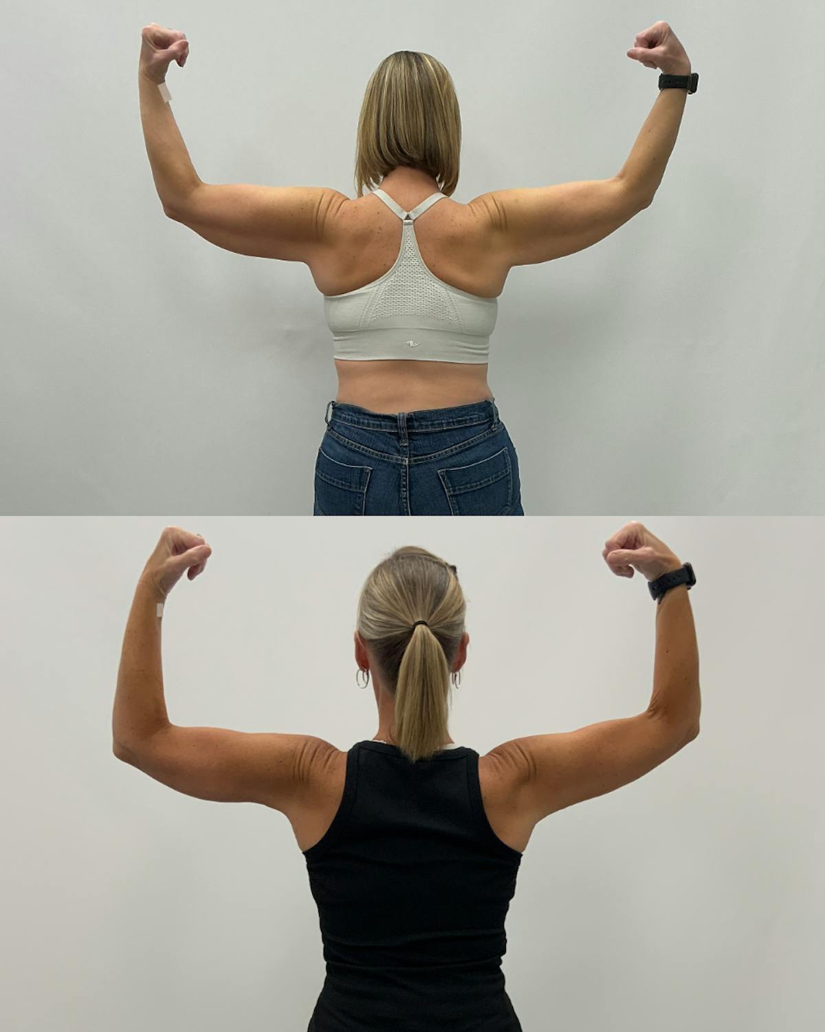 Arm Lift Before & After Gallery - Patient 238543 - Image 4