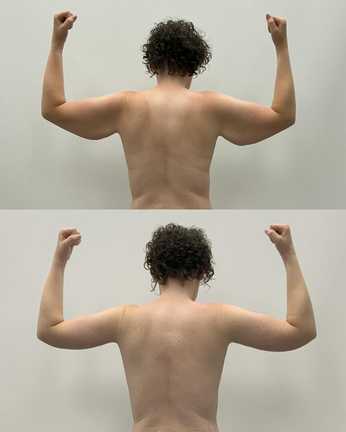 Arm Lift Before & After Gallery - Patient 702808 - Image 3