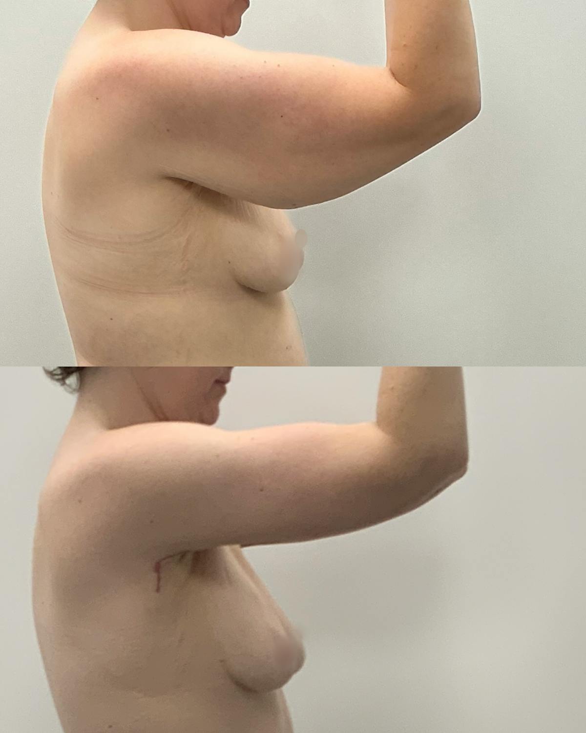 Arm Lift Before & After Gallery - Patient 702808 - Image 1