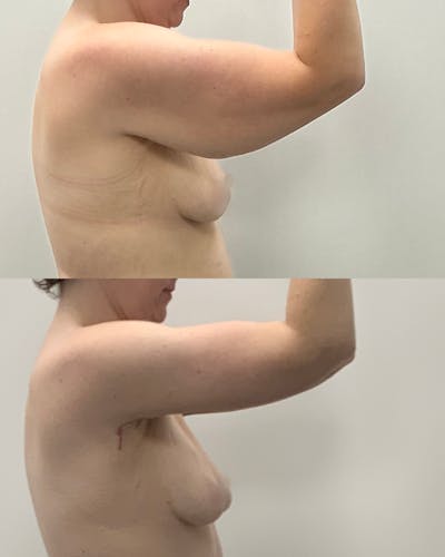 Arm Lift Before & After Gallery - Patient 702808 - Image 1