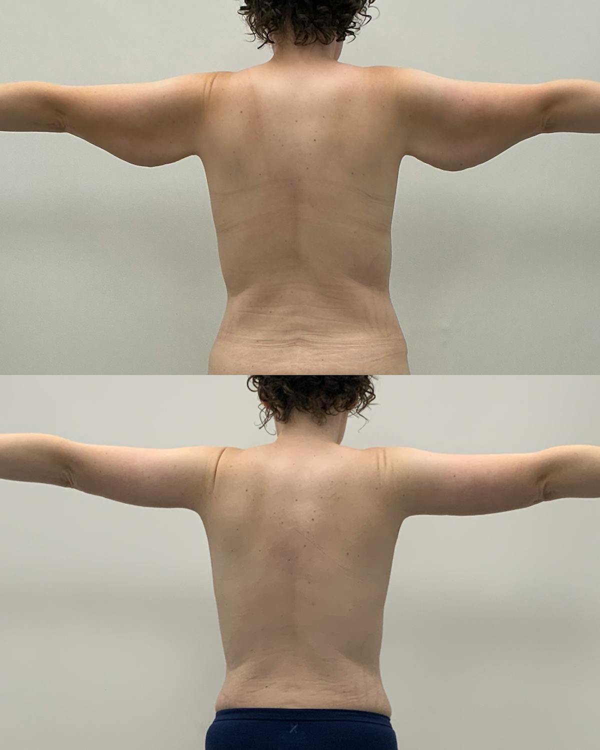 Arm Lift Before & After Gallery - Patient 702808 - Image 4