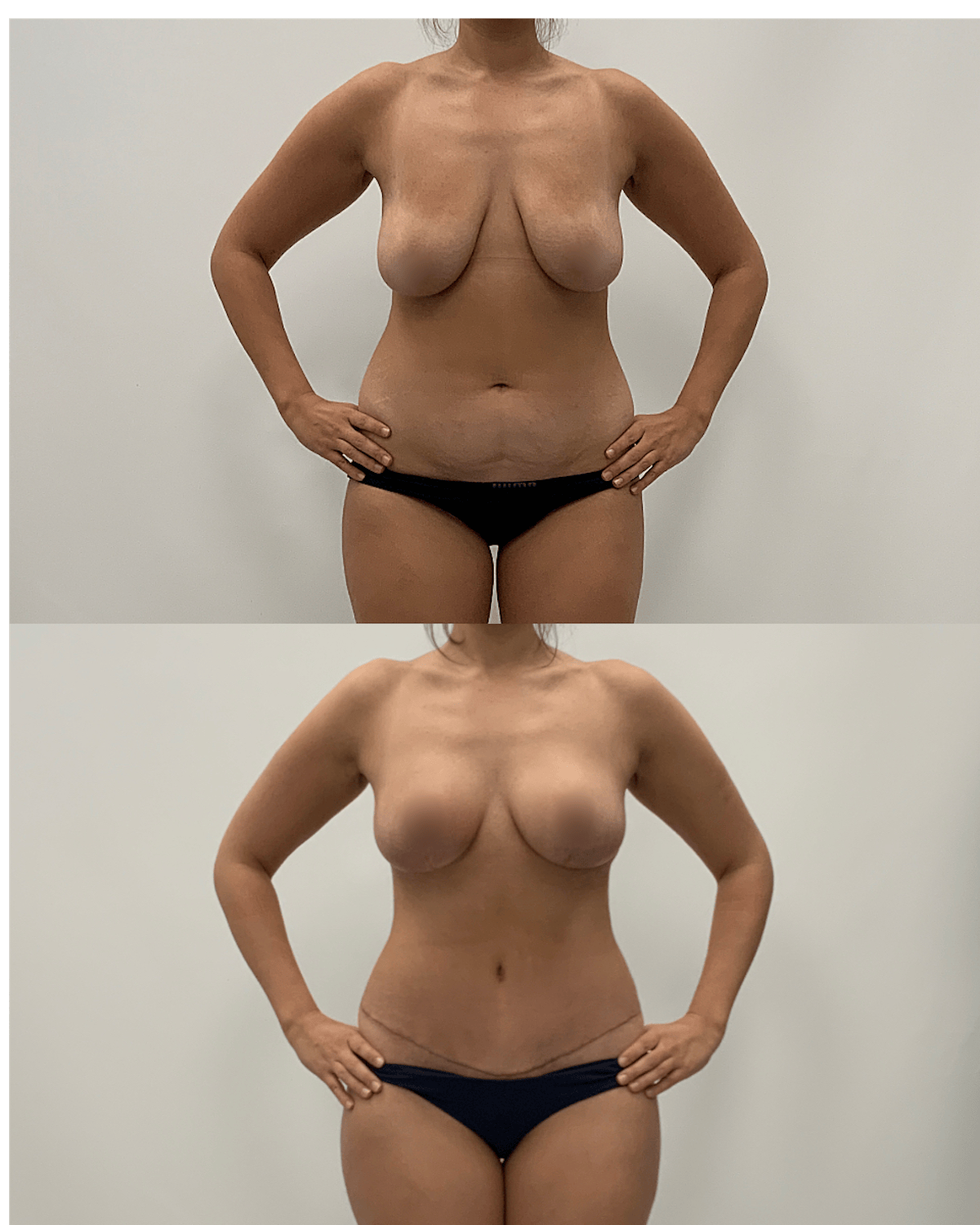 Mommy Makeover Before & After Gallery - Patient 379603 - Image 1