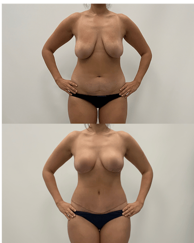 Mommy Makeover Before & After Gallery - Patient 379603 - Image 1
