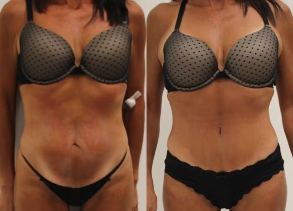 Tummy Tuck Before & After Gallery - Patient 630991 - Image 1
