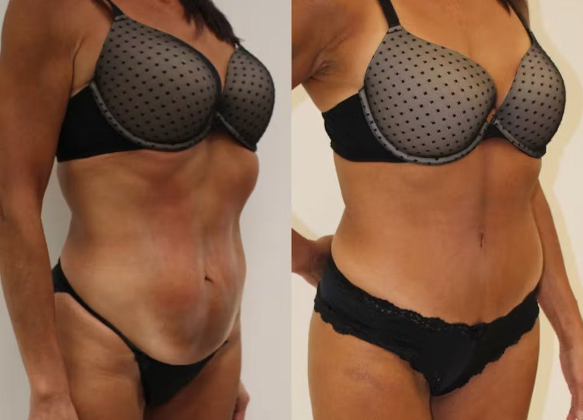 Tummy Tuck Before & After Gallery - Patient 630991 - Image 2