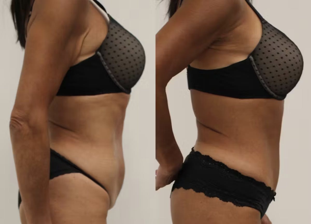 Tummy Tuck Before & After Gallery - Patient 630991 - Image 3