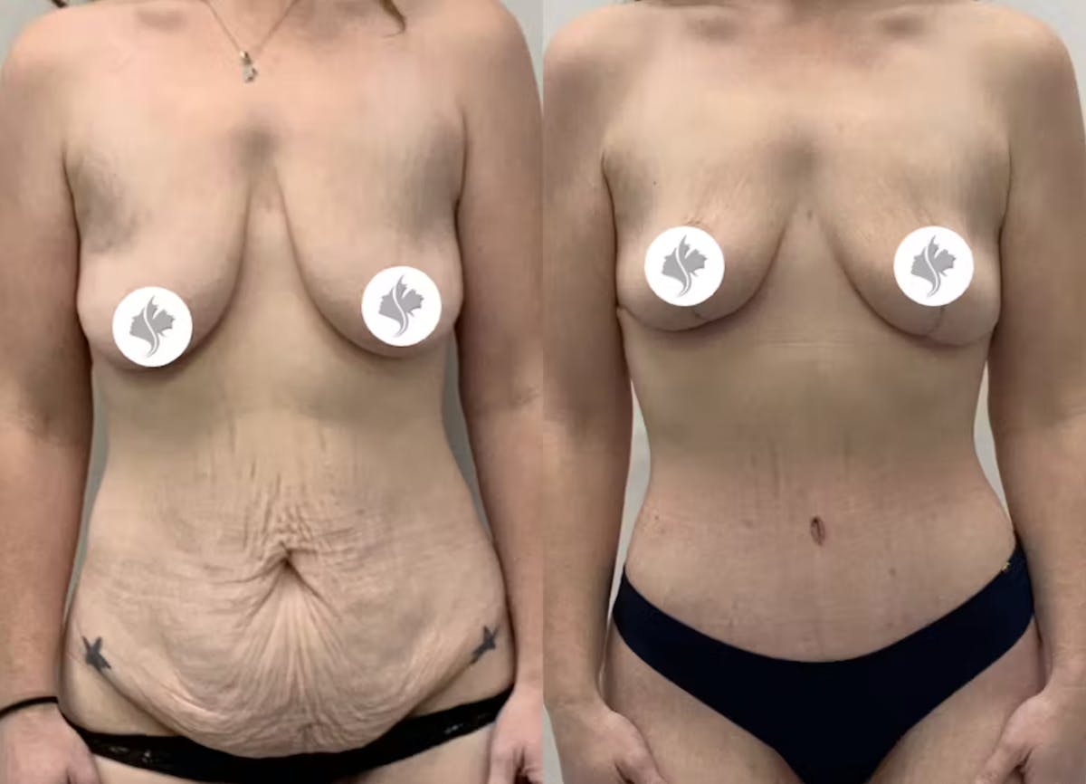 Tummy Tuck Before & After Gallery - Patient 402216 - Image 1