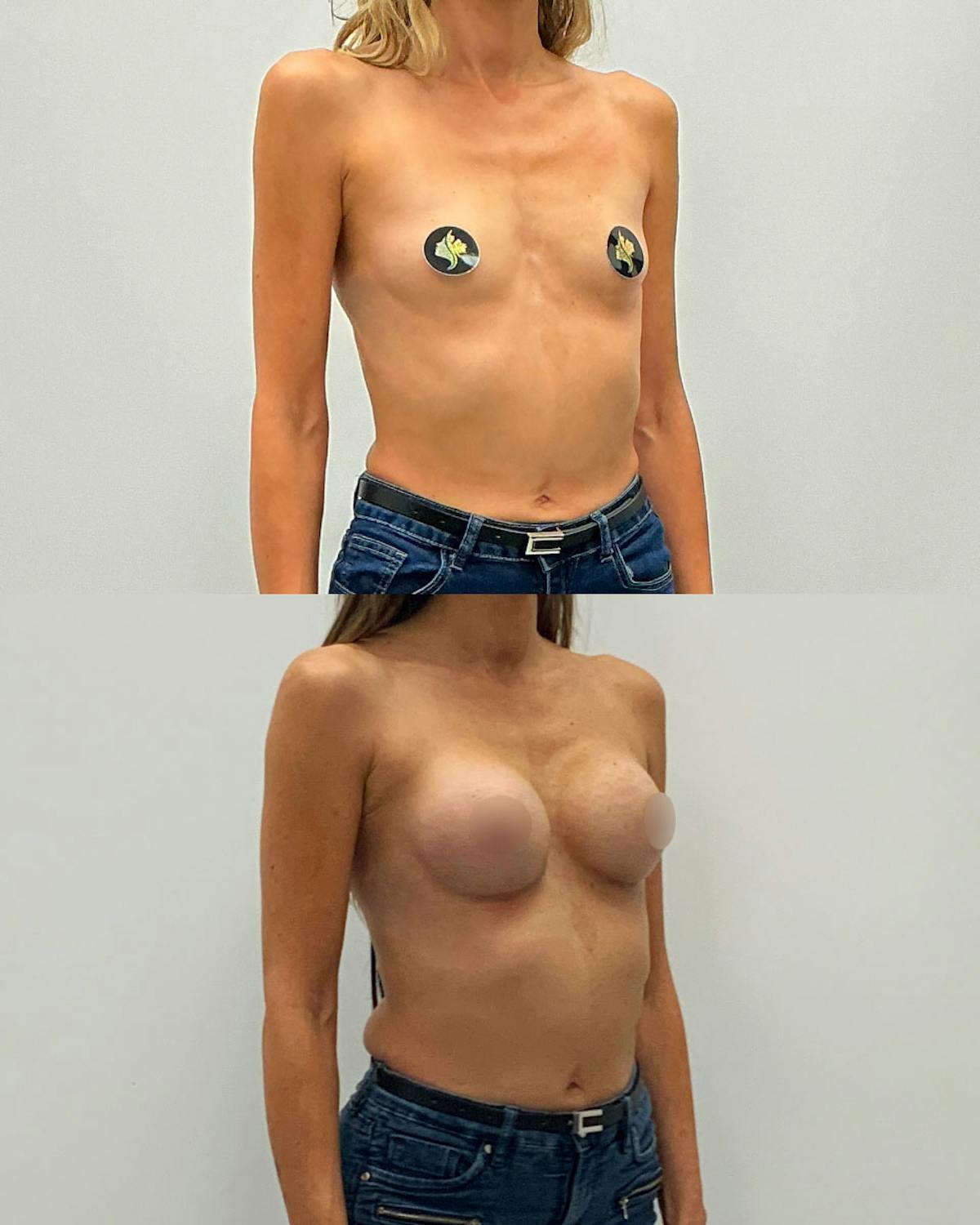 Breast Augmentation Before & After Gallery - Patient 306114 - Image 2