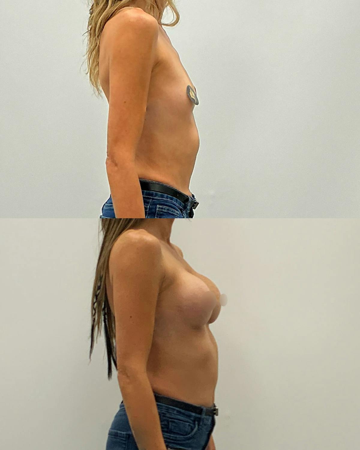 Breast Augmentation Before & After Gallery - Patient 306114 - Image 3