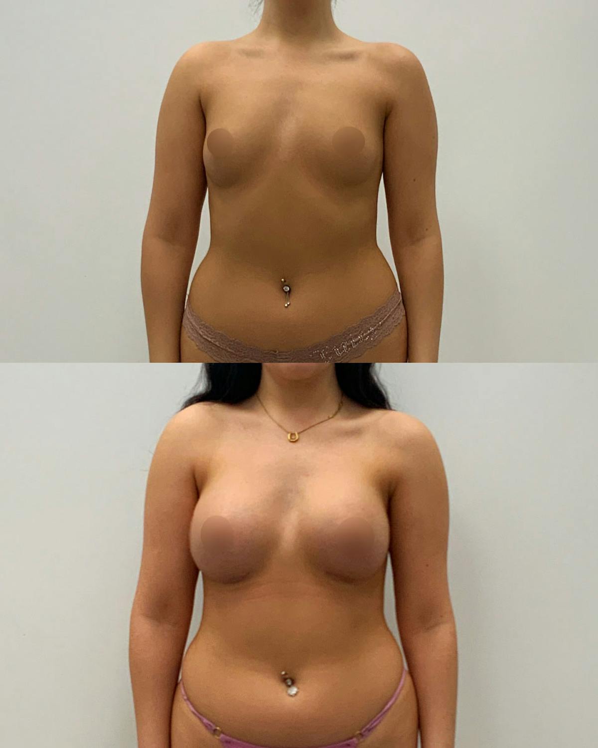 Breast Augmentation Before & After Gallery - Patient 420741 - Image 1