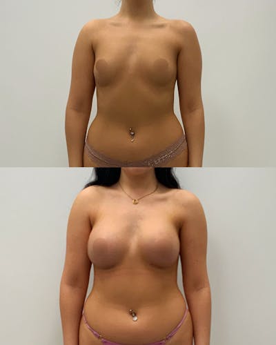 Breast Augmentation Before & After Gallery - Patient 420741 - Image 1
