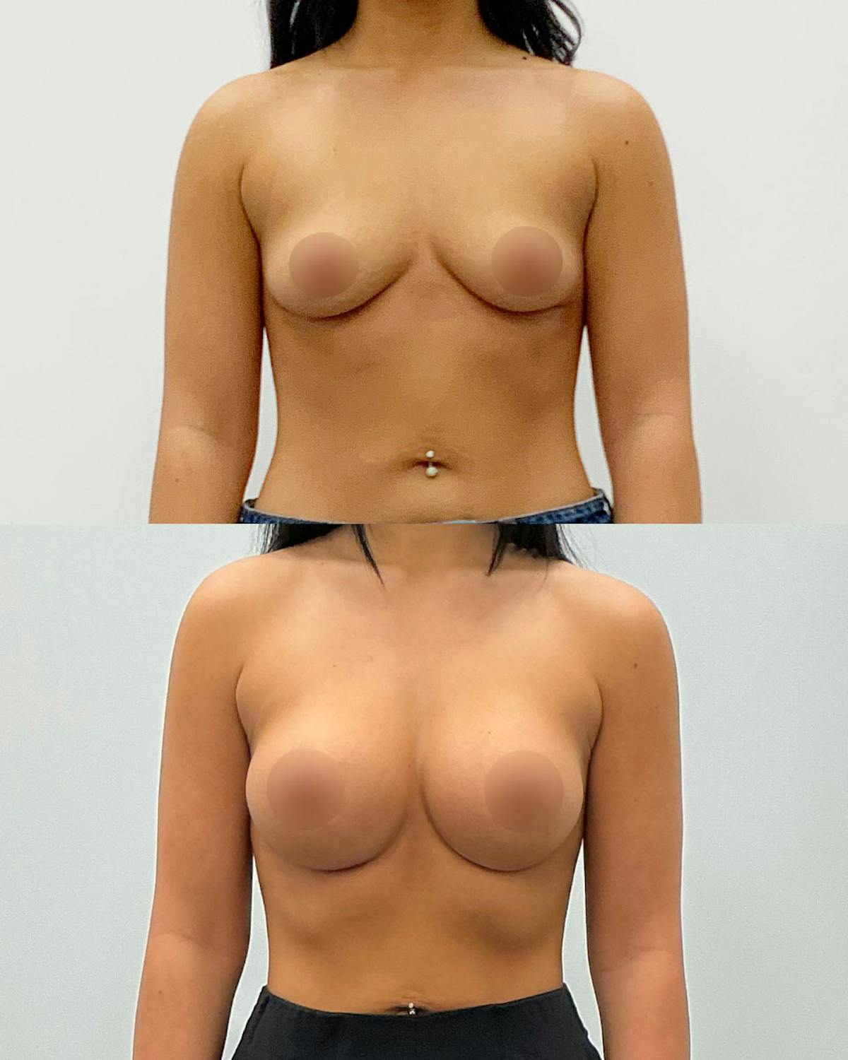 Breast Augmentation Before & After Gallery - Patient 163791 - Image 1