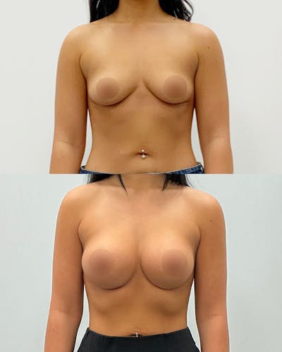 Breast Augmentation Before & After Gallery - Patient 163791 - Image 1