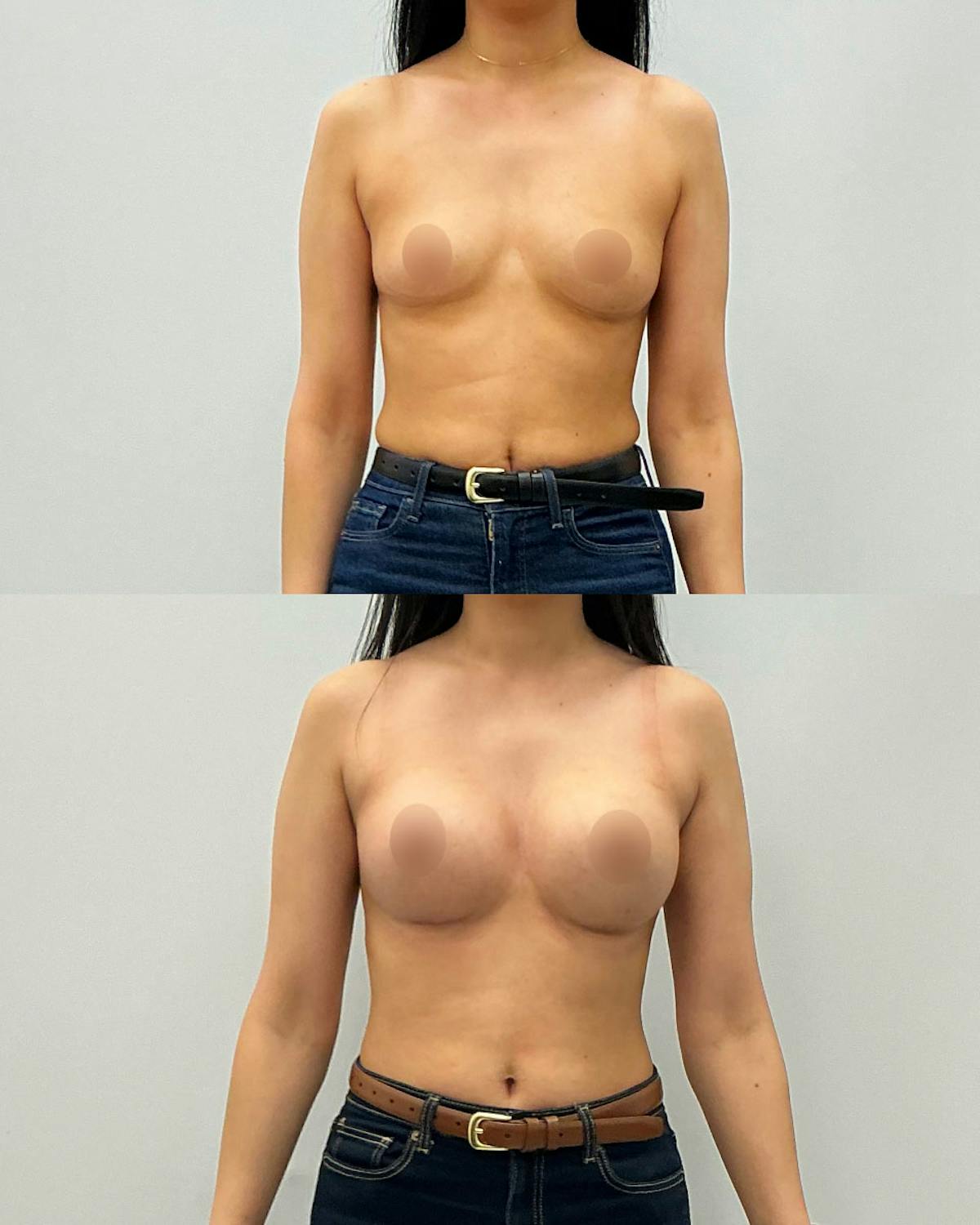 Breast Augmentation Before & After Gallery - Patient 353297 - Image 1