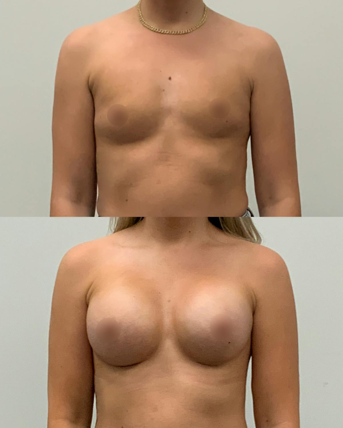 Breast Augmentation Before & After Gallery - Patient 200963 - Image 1