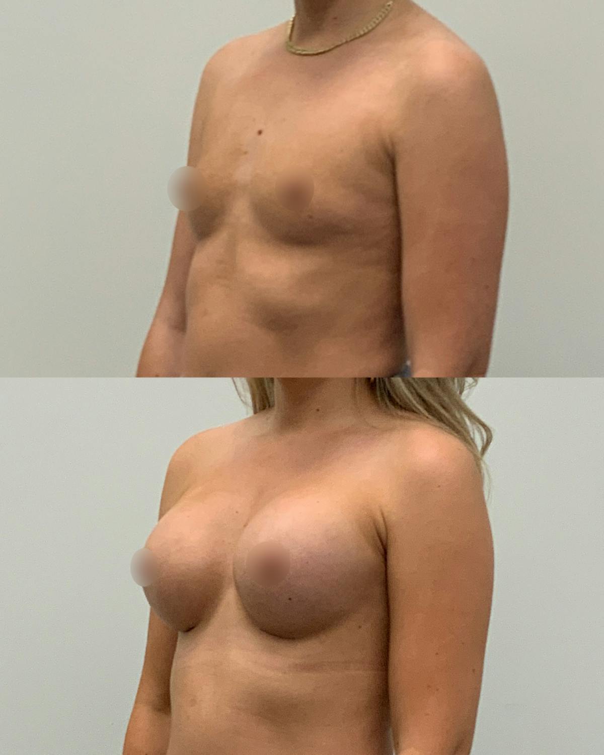 Breast Augmentation Before & After Gallery - Patient 200963 - Image 2