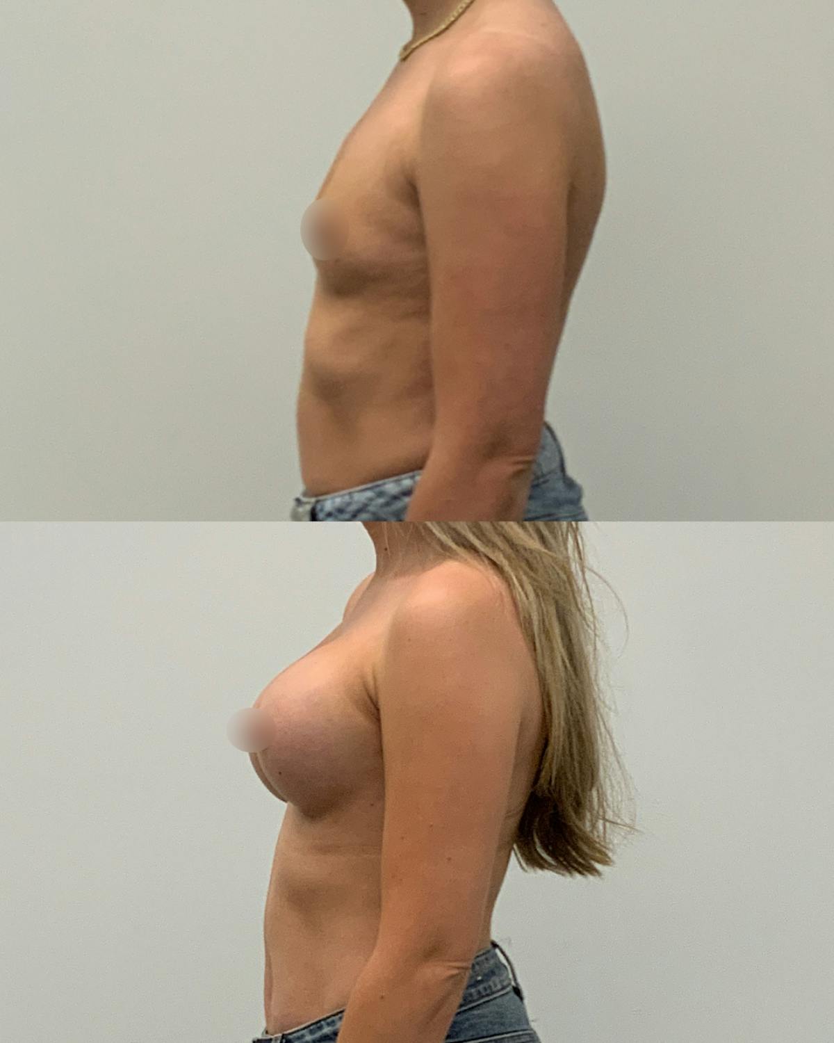 Breast Augmentation Before & After Gallery - Patient 200963 - Image 3