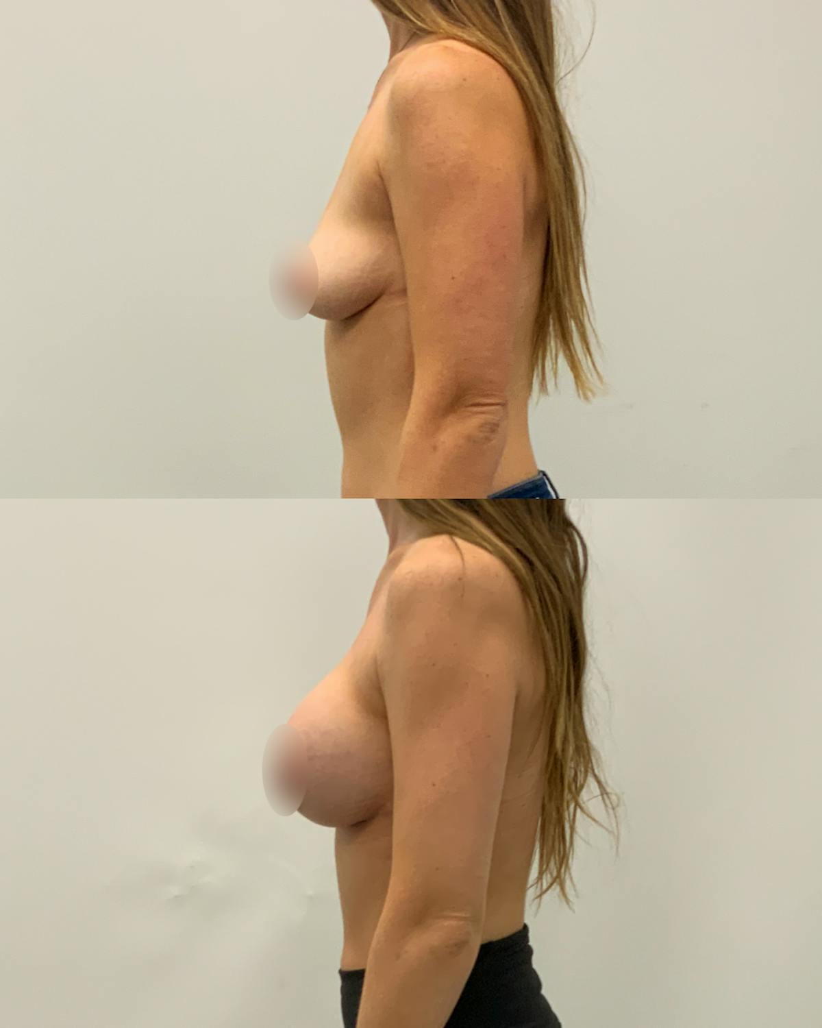 Breast Augmentation Before & After Gallery - Patient 406893 - Image 3