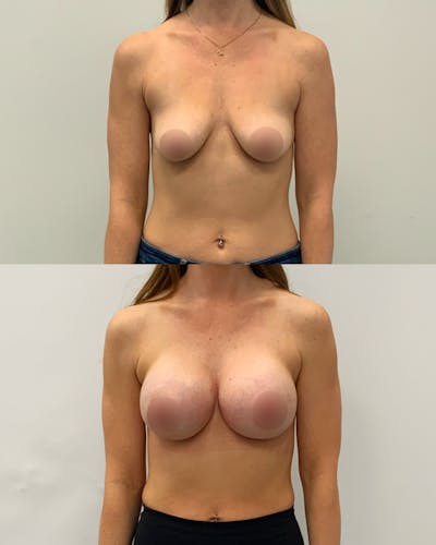 Breast Augmentation Before & After Gallery - Patient 406893 - Image 1