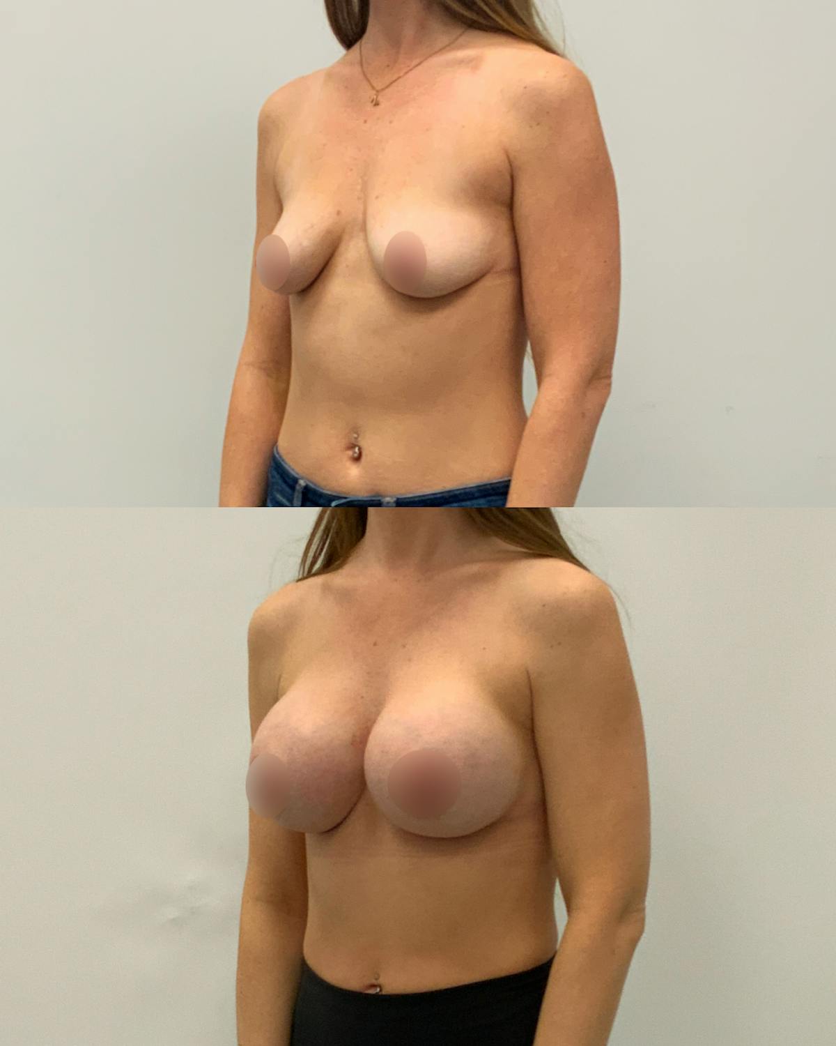 Breast Augmentation Before & After Gallery - Patient 406893 - Image 2