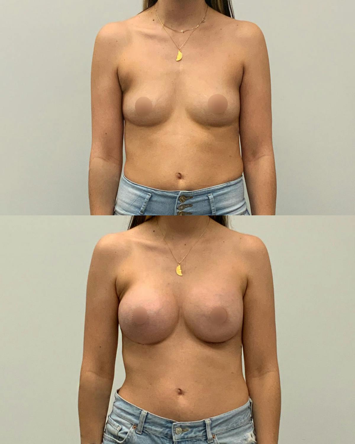 Breast Augmentation Before & After Gallery - Patient 420224 - Image 1