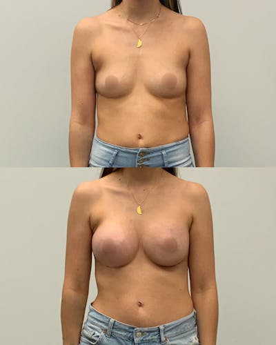 Breast Augmentation Before & After Gallery - Patient 420224 - Image 1