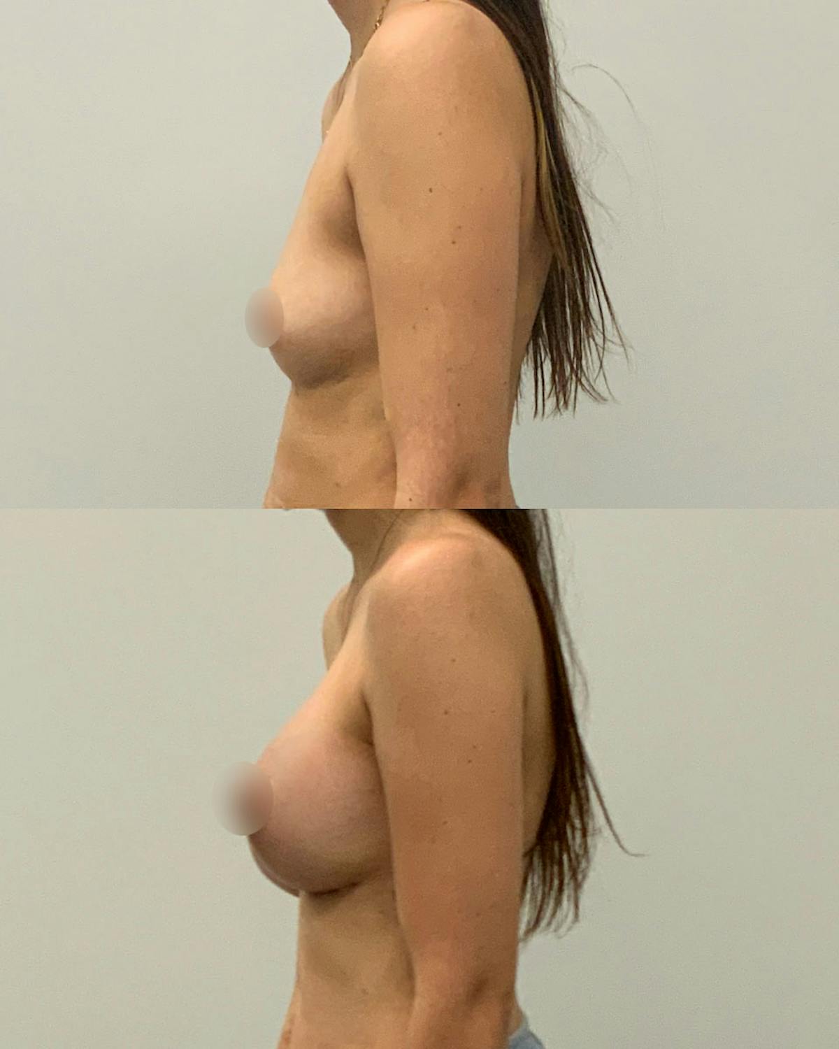 Breast Augmentation Before & After Gallery - Patient 420224 - Image 3
