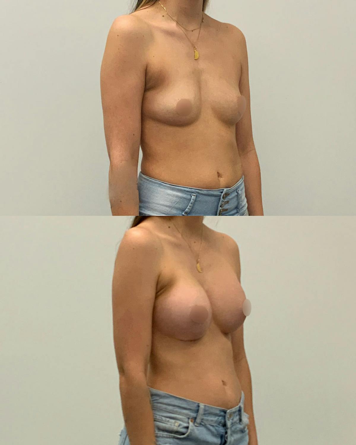 Breast Augmentation Before & After Gallery - Patient 420224 - Image 2