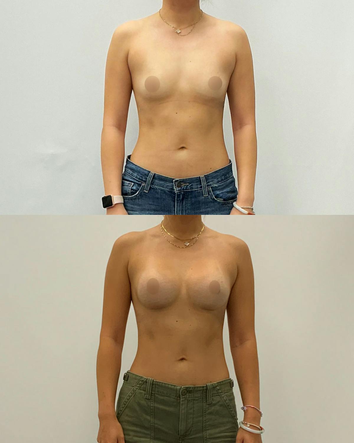 Breast Augmentation Before & After Gallery - Patient 176842 - Image 1