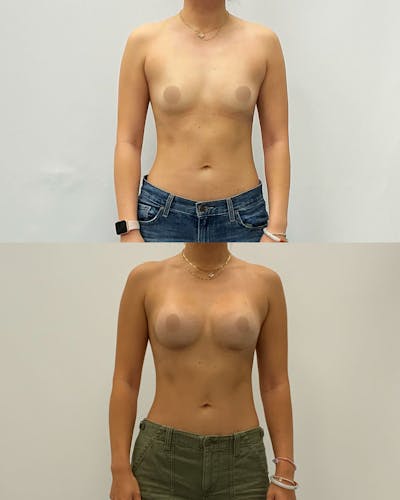 Breast Augmentation Before & After Gallery - Patient 176842 - Image 1