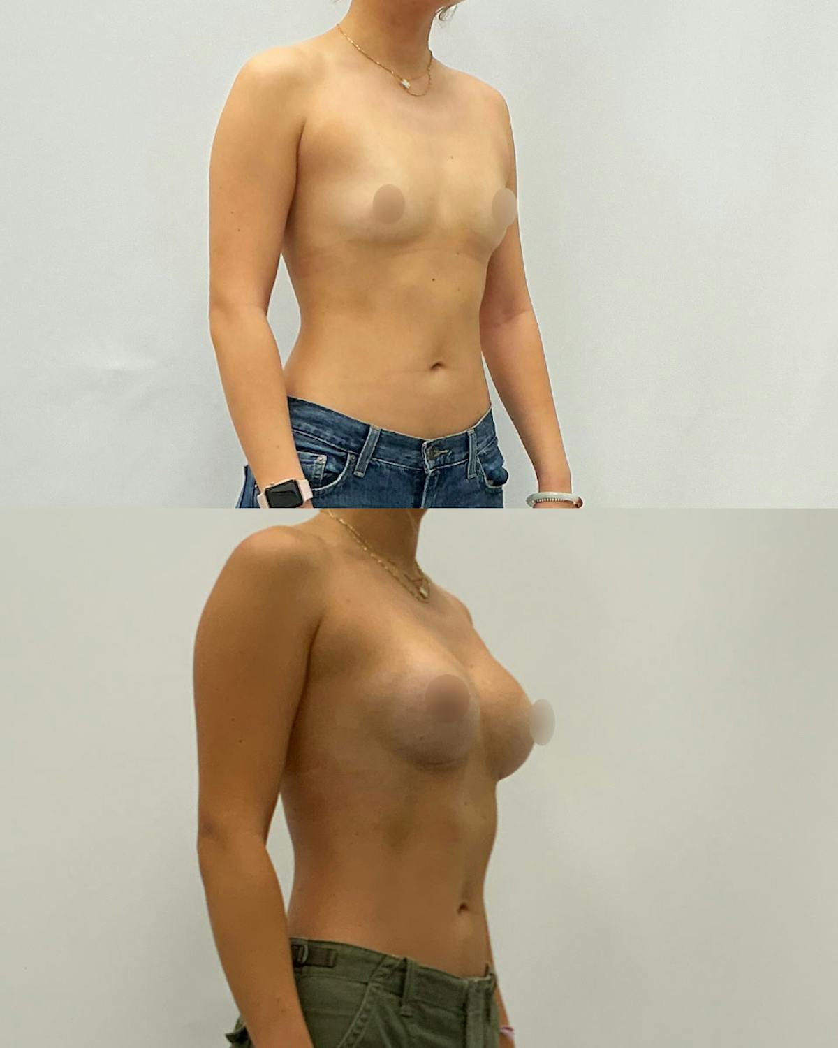 Breast Augmentation Before & After Gallery - Patient 176842 - Image 2