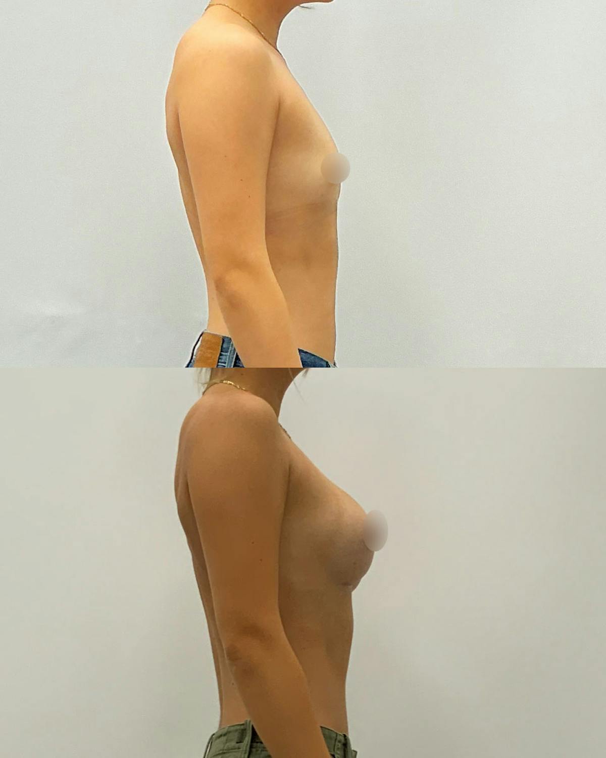 Breast Augmentation Before & After Gallery - Patient 176842 - Image 3