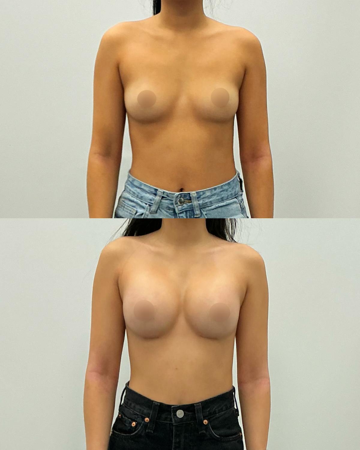 Breast Augmentation Before & After Gallery - Patient 136956 - Image 1
