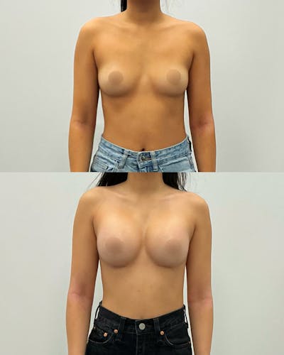 Breast Augmentation Before & After Gallery - Patient 136956 - Image 1