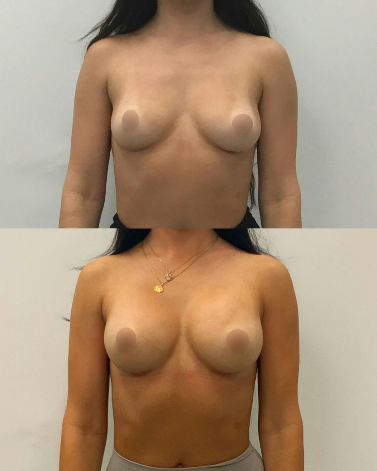 Breast Augmentation Before & After Gallery - Patient 410841 - Image 1