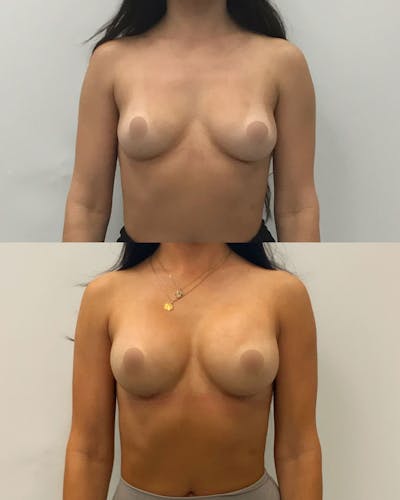 Breast Augmentation Before & After Gallery - Patient 410841 - Image 1