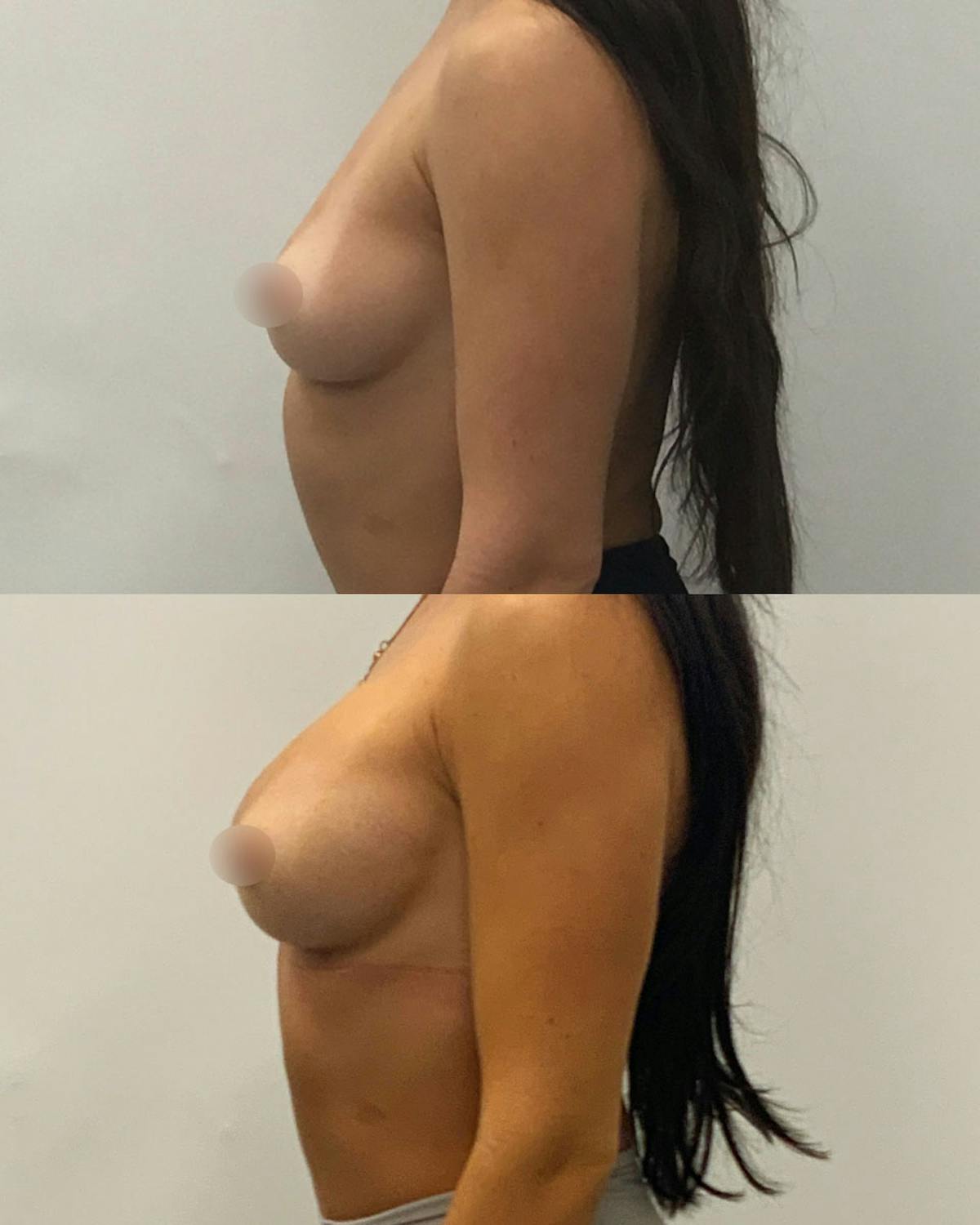 Breast Augmentation Before & After Gallery - Patient 410841 - Image 3