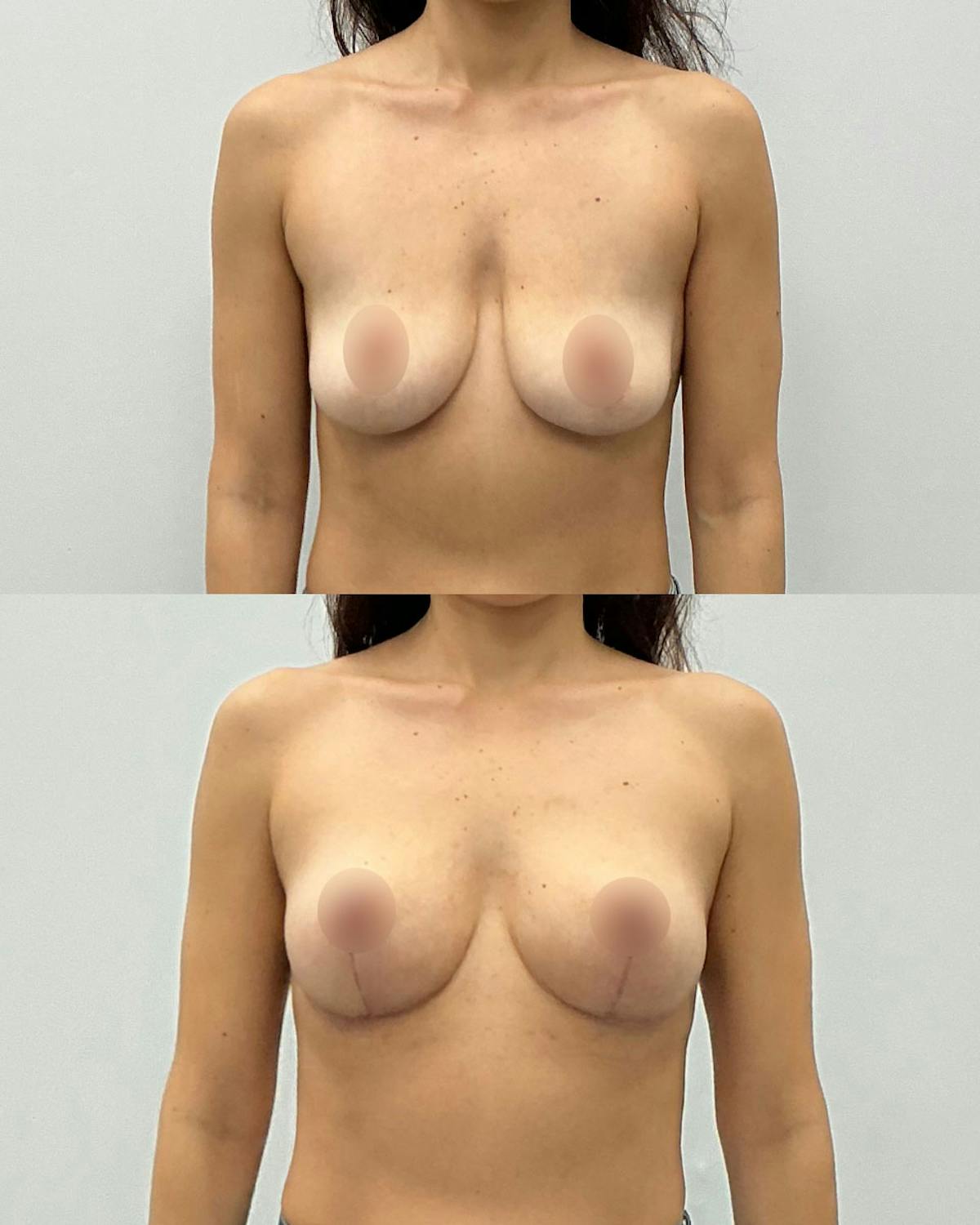 Breast Lift Before & After Gallery - Patient 377832 - Image 1