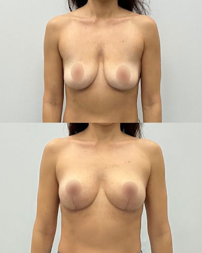Breast Lift Before & After Gallery - Patient 377832 - Image 1