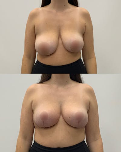 Breast Lift Before & After Gallery - Patient 359567 - Image 1