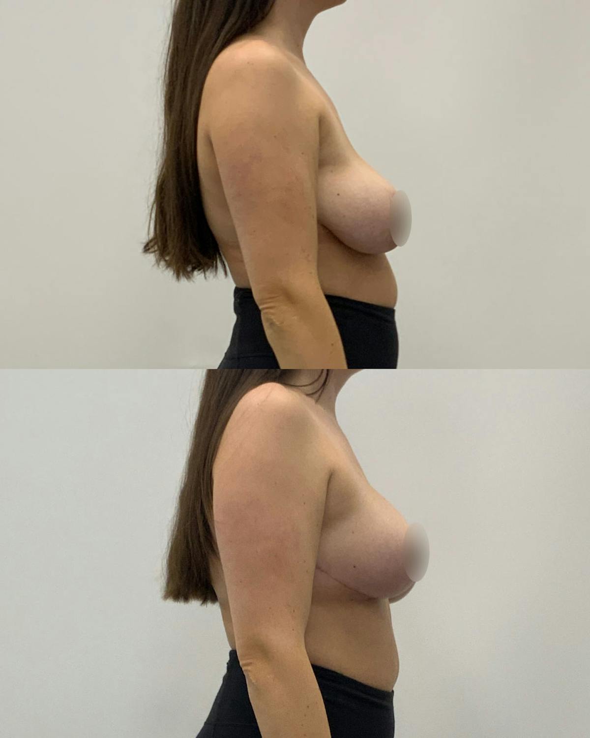 Breast Lift Before & After Gallery - Patient 359567 - Image 3