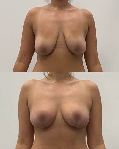 Breast Lift Before & After Gallery - Patient 641658 - Image 1