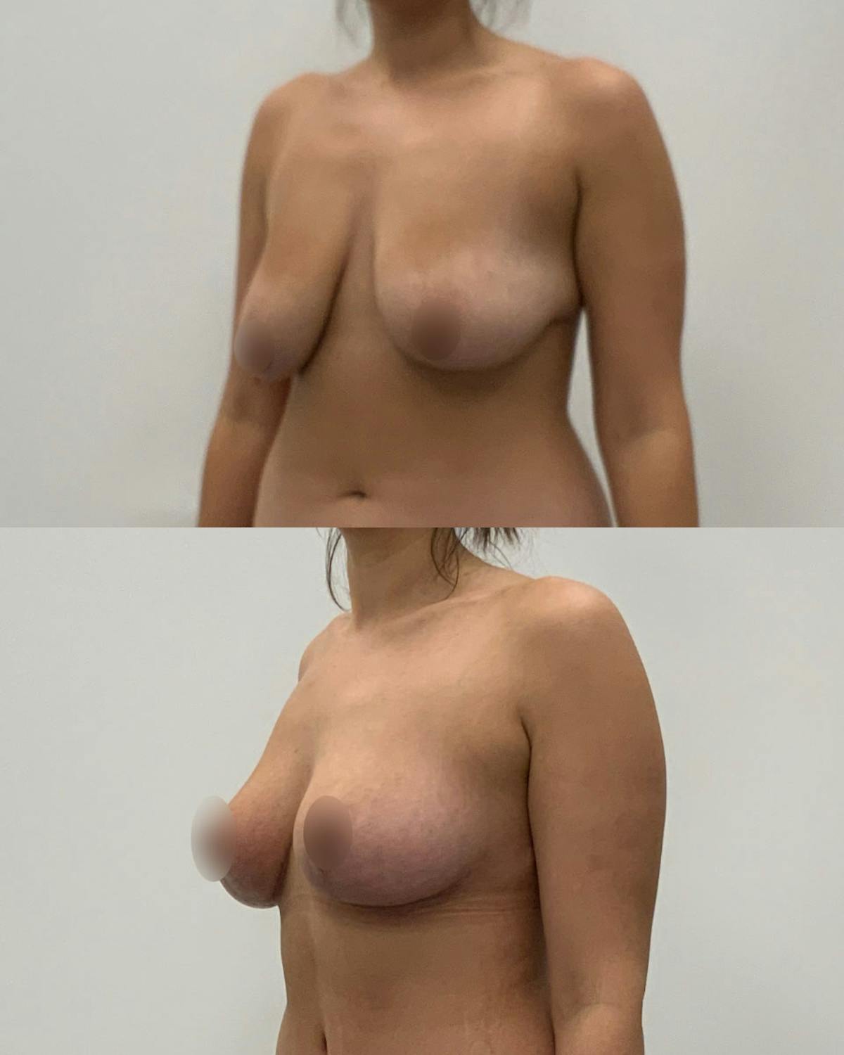 Breast Lift Before & After Gallery - Patient 641658 - Image 2